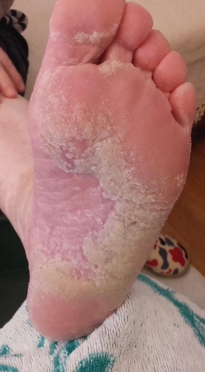 Athletes Foot Solution