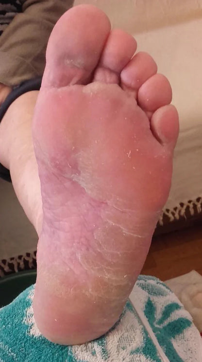 Athletes Foot Solution